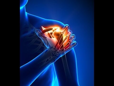 علائم سندرم گیر افتادگی شانه