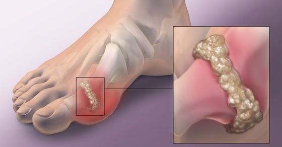 پیشگیری از ابتلا به نقرس