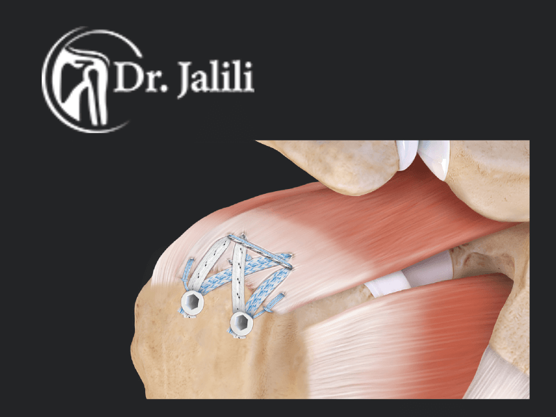 پیشگیری-از -پارگی-لابروم-شانه