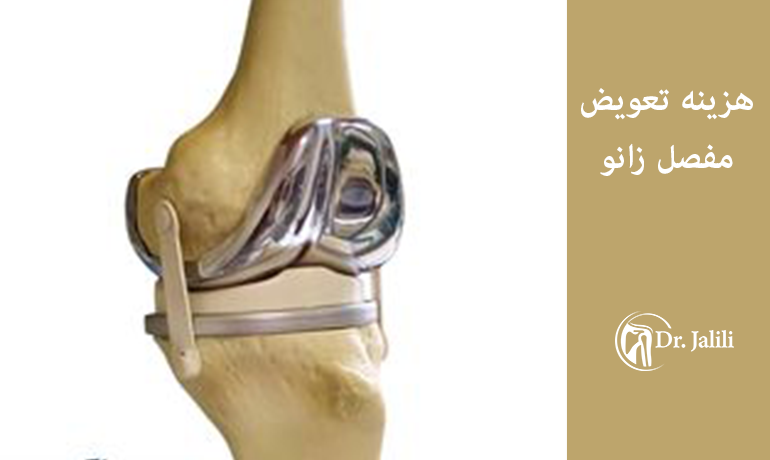 هزینه تعویض مفصل زانو