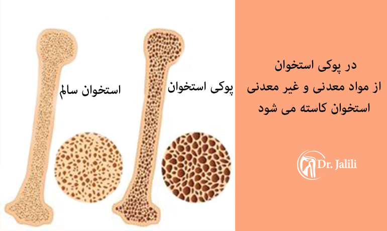 پوکی استخوان و کاهش مواد معدنی و غیر معدنی استخوان