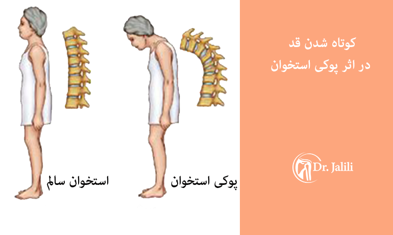 پوکی استخوان و کوته شدن قد