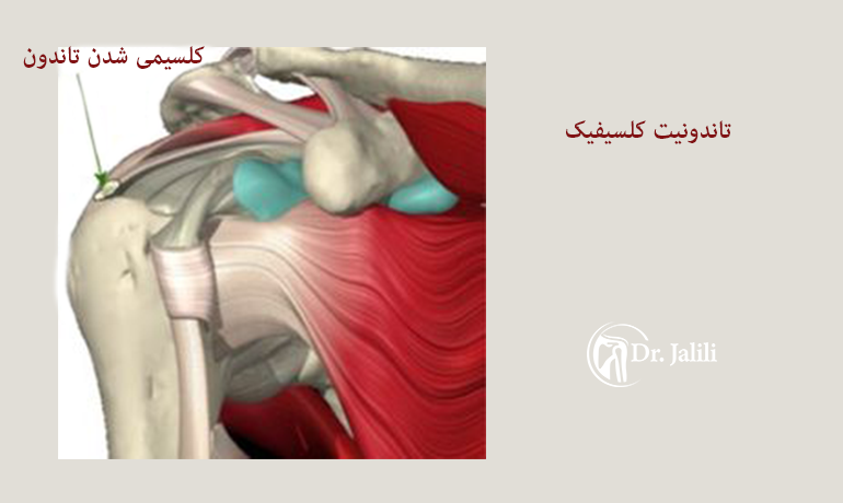 تاندونیت کلسیفیک