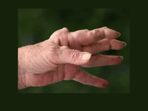 روماتیسم - دکتر جلیلی