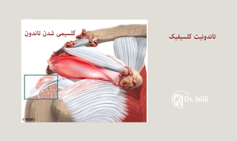 کلسیمی شدن تاندون