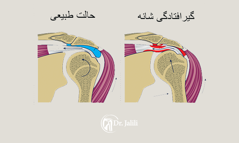 گیر افتادگی شانه